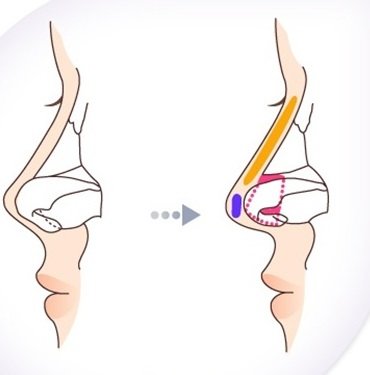 Phẫu thuật chỉnh sửa mũi hếch CAM KẾT an toàn, mũi đẹp tự nhiên 126