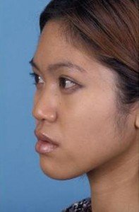 Massage có ảnh hưởng đến kết quả sau nâng mũi không?