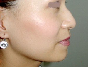 Sửa mũi gồ cần băng ép trong bao lâu? 1
