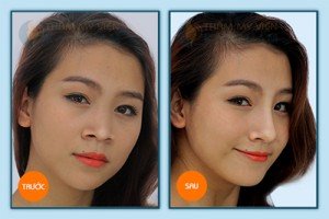 Phẫu thuật nâng mũi được bao lâu?