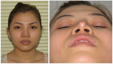 Sửa mũi bị méo phải làm sao? Sửa mũi bị méo phải làm sao