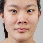 Lỗ mũi to phải làm sao? – Bác sĩ tư vấn