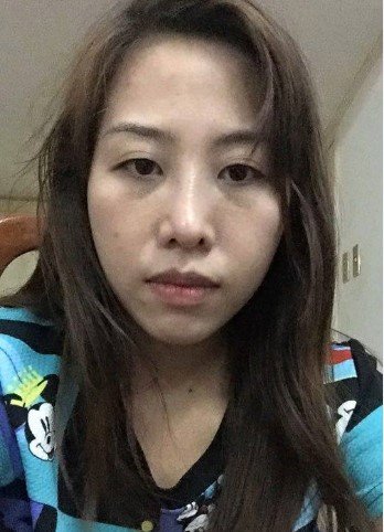 nâng mũi xong bị lệch 1