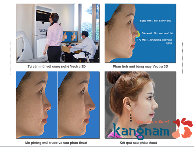 Vectra XT cho phép xem trước hình dáng mũi sau nâng Chi phí nâng mũi s line hết bao nhiêu tiền