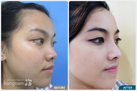 Hình ảnh trước và sau nâng mũi777