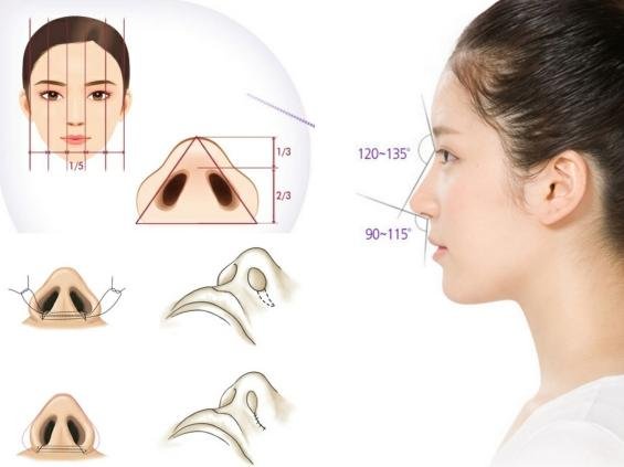 Cắt cánh mũi đẹp, mũi chữ A thon gọn, an toàn tuyệt đối 4
