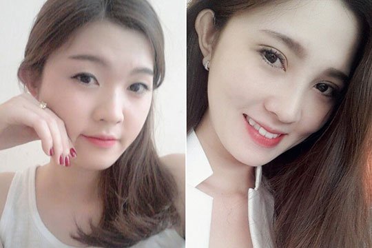 Nâng mũi đẹp: Chuẩn Hàn Quốc - Giá "Việt Nam" 3