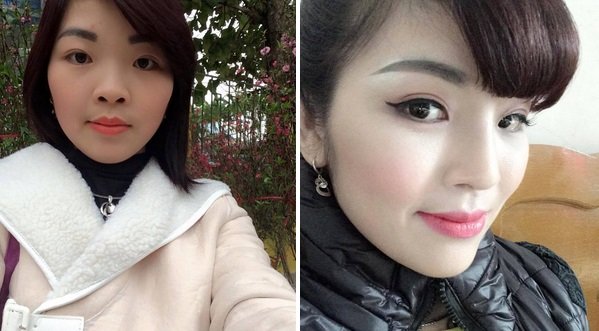Nâng mũi có ảnh hưởng gì không và có an toàn không? 4